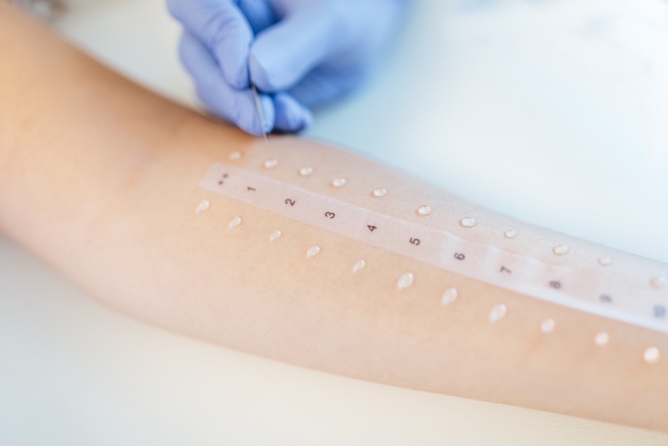 W Allergie PRICK-Test